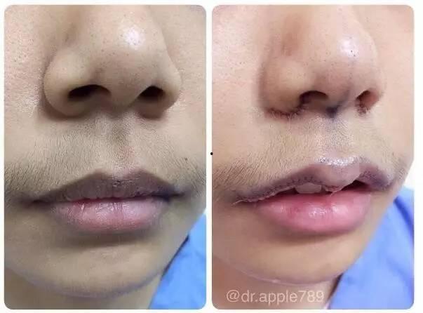 缩唇手术视频,术前术后注意事项及效果展示