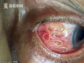 眼睛寄生虫手术视频,揭秘手术过程与挑战