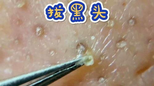 拔黑头粉刺视频,视频教学带你高效清洁毛孔