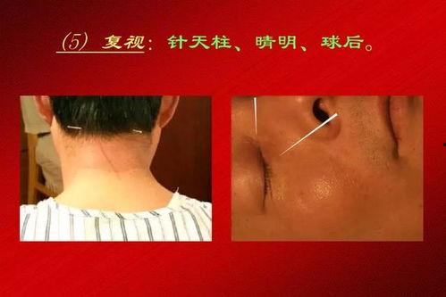 醒脑开窍针刺法视频,传统中医与现代科技的完美融合